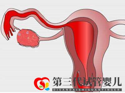 子宮肌瘤做俄羅斯試管嬰兒的成功率高嗎？(圖1)