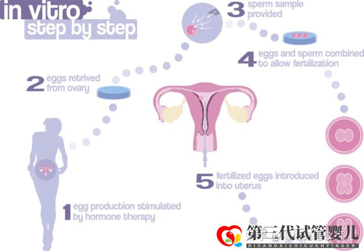 試管嬰兒1代、2代、3代、4代哪個(gè)最好真實(shí)操作過(guò)...(圖3)