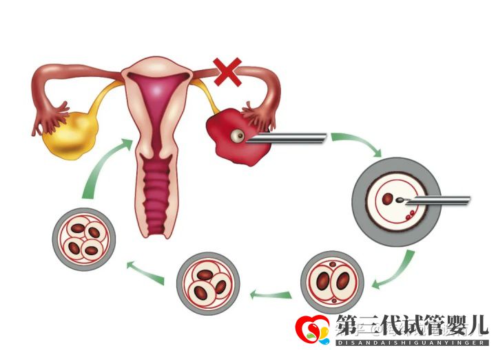 試管嬰兒1代、2代、3代、4代哪個(gè)最好真實(shí)操作過(guò)...(圖7)