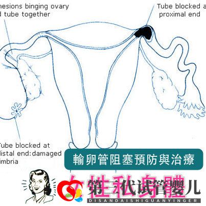 輸卵管堵塞,懷孕到底有多難(圖3)