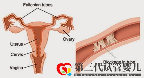 輸卵管堵塞,懷孕到底有多難(圖5)