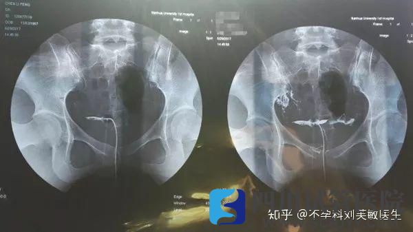 輸卵管究竟通不通2分鐘教你看懂輸卵管造影片子(圖2)